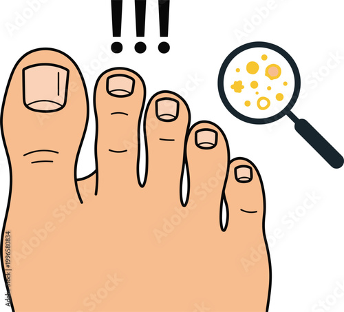 Toenail fungus infection illustration featuring foot nail condition with magnified bacteria detail and dermatology health problem vector design