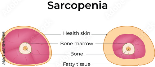 Sarcopenia Muscle Loss and Healthy Limb Cross-Section Comparison Design Vector