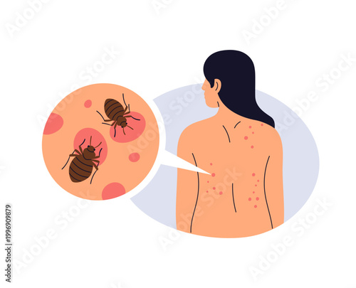 Bedbug bite on skin. Red spots, rash, irritation reaction on human body, back. Cimex insect, parasite. Redness, allergy marks from bed bugs. Flat vector illustration isolated on white background
