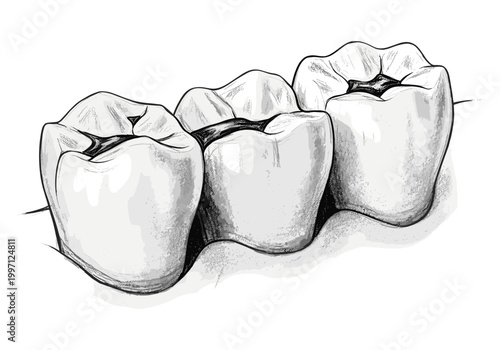 Close-up illustration of three molars with dark fillings in a row