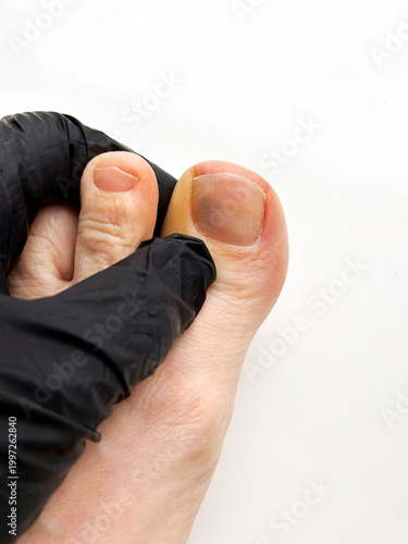Close-up of bruised toenail on human foot examined by gloved hand, podiatry and nail trauma concept.