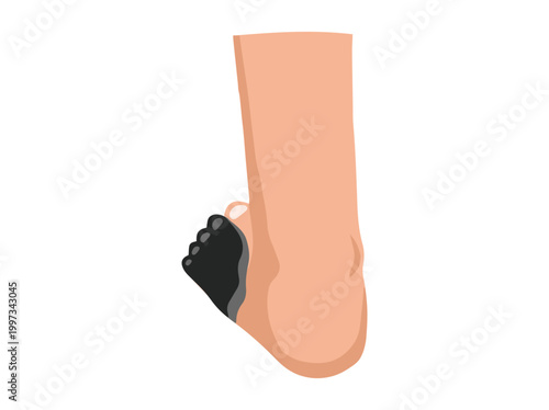 Diabetic Foot Gangrene Ulcers Clip Art
