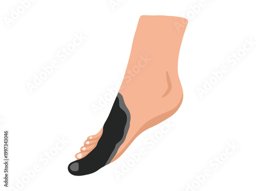 Diabetic Foot Gangrene Ulcers Clip Art
