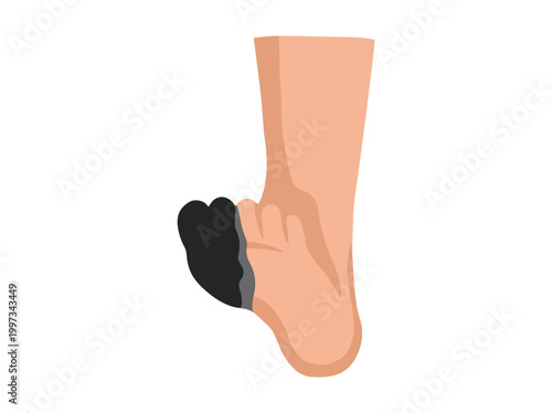 Hand Drawn Diabetic Foot Gangrene Ulcers
