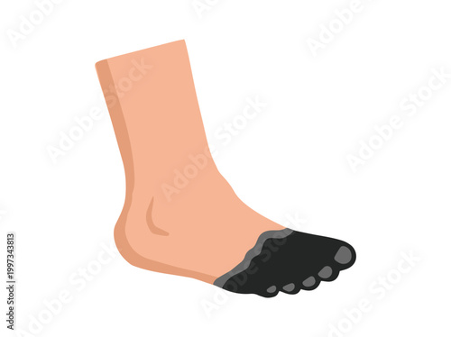 Diabetic Foot Gangrene Ulcers Illustration