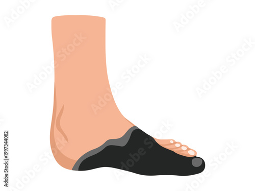 Diabetic Foot Gangrene Ulcers Illustration