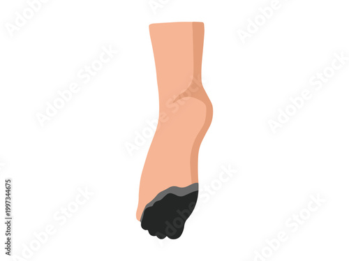 Diabetic Foot Gangrene Ulcers Clip Art
