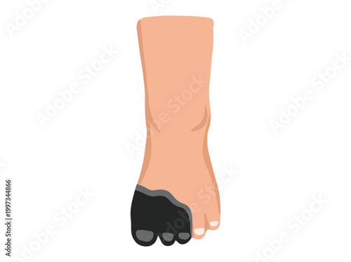 Diabetic Foot Gangrene Ulcers Clip Art
