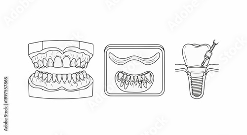 Dental models and implant placement illustration