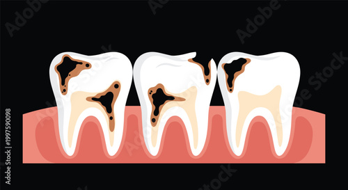 Medical illustration showing three human teeth with significant decay and dark cavities affecting the enamel and gum line for dental health awareness.