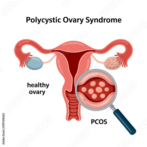 Polycystic ovary syndrome PCOS healthy ovary anatomy illustration