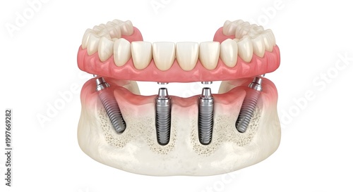 3D Medical Illustration of All-on-4 Dental Implant System with Full Arch Prosthesis