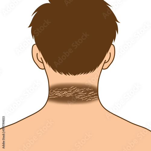 Diabetes man dark around neck skin, illustration cartoon on white background