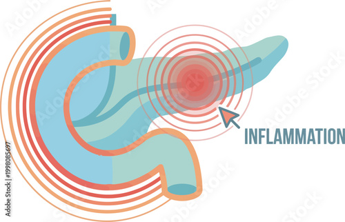 Pancreas inflammation medical vector illustration