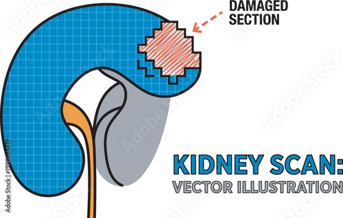 Kidney scan vector illustration showing damaged section
