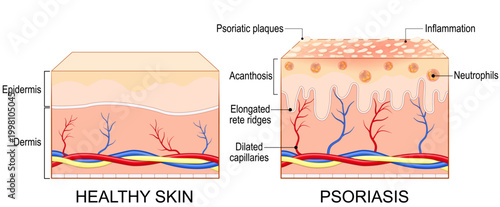 Psoriasis. Autoimmune skin condition.