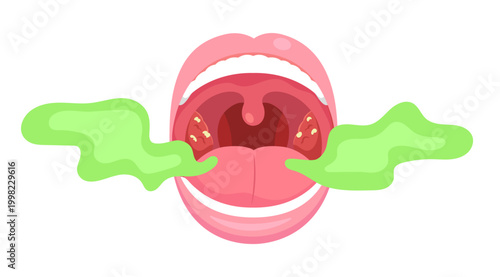 Bad breath mouth beacuse of tonsil stone. Flat vector of smelly mouth, oral health, hygiene.