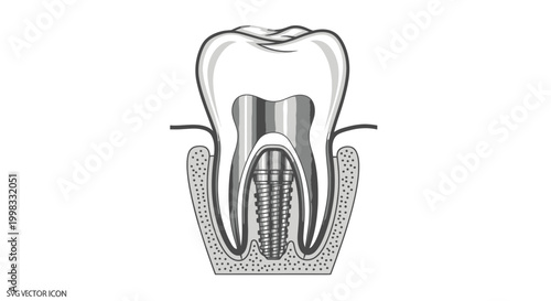 Dental Implant Cross Section Illustration - Tooth Replacement and Bone Integration