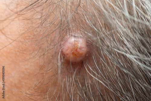 Close-up of scalp cyst (sebaceous cyst), small lump on human scalp caused by blocked oil glands, common skin condition, healthcare and dermatology concept