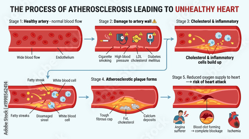 Diagram illustrating the progression of atherosclerosis leading to arterial narrowing and
