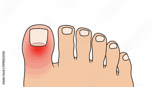 Ingrown toenail, toe pain, foot health, medical illustration, red inflamed toe