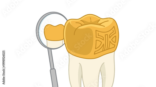 Illustration of a gold dental crown on a tooth with a dental mirror.