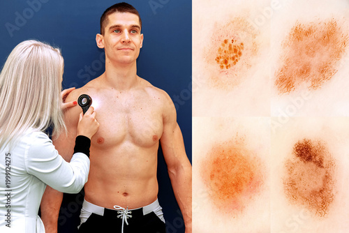 The doctor performs a dermatoscopy. Prevention of skin cancer. Normal skin nevi.