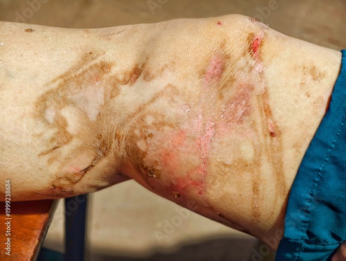 Close-up of a recovering second-degree thermal burn on a leg. Showing skin regeneration, hyper-pigmentation, and scar tissue formation after a scalding water injury. Ideal for medical education.