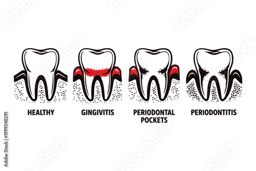 Illustration of gum disease stages from healthy to periodontitis Vector