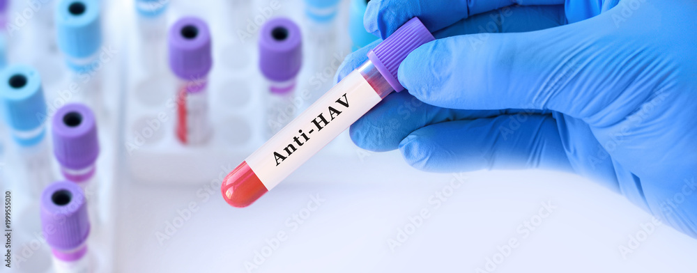 Naklejka premium Doctor holding anti HAV blood test tube explaining detection of hepatitis A antibodies for viral immunity evaluation, infection diagnosis and preventive clinical laboratory screening