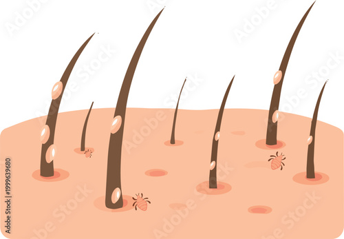 illustration of human scalp with head lice and nits attached to hair strands. Suitable for healthcare, hygiene, dermatology, and hair care concepts.