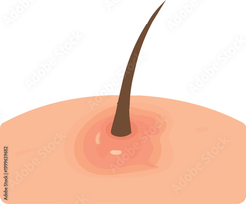 illustration of inflamed human scalp showing redness and irritation around a hair follicle. Suitable for dermatology, healthcare, and hair care concepts.