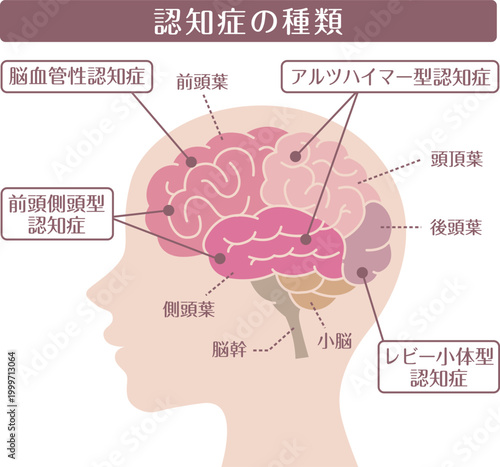 Dementia types brain diagram side view flat