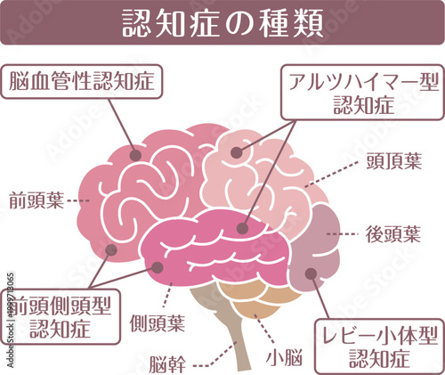 Types of dementia brain illustration flat style
