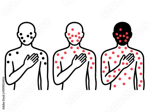 Monkeypox (Mpox) Virus Infection Symptoms Set, Human Silhouettes with Skin Rash, Pustules and Blisters Graphic