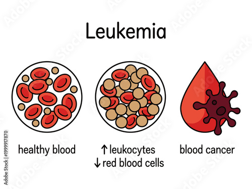 Leukemia medical infographic showing healthy blood versus blood cancer, highlighting high leukocytes and low red blood cells for educational oncology presentations.
