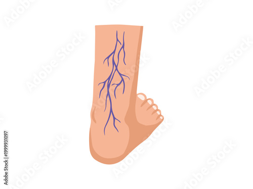 Hand Drawn Varices Foot Illustration
