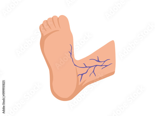 Hand Drawn Varicose Veins Foot 
