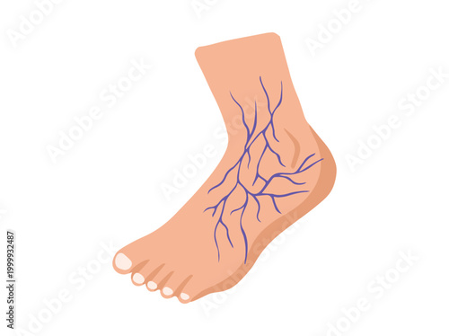 Varicose Veins Foot or Varices Foot