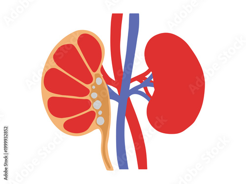 Hand Drawn Human Kidney Stones Disease
