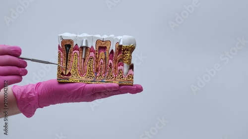 dentist wearing pink gloves demonstrates an anatomical model of teeth with an implant and caries.