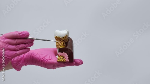 Model of a tooth with periodontitis: a dentist points to tartar and makes a thumbs-down gesture.