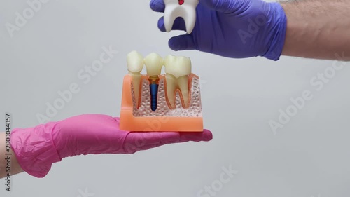 Dental bridge placement on implant and natural teeth anatomical model