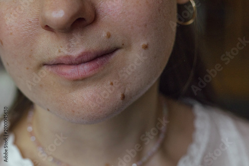 Fotografía Close-up of a woman's lower face with visible moles (nevi) and natural skin texture