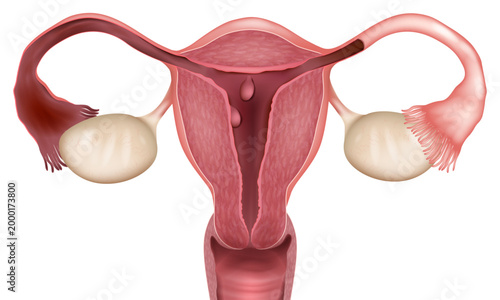 Female Reproductive System Anatomy with Endometrial Polyps Uterus Pathology Diagram Showing Uterine Polyps. Medical Illustration of Human Womb with Endometrium Abnormalities 