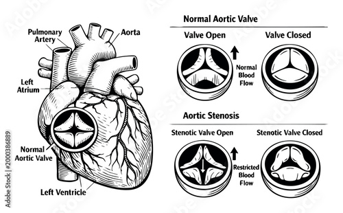 Human heart anatomy with a comparison of normal aortic valve function and stenotic valve impacting blood flow in a medical illustration