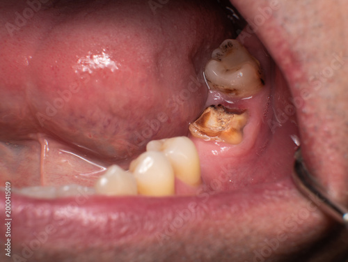 Quadro em tela Severely destroyed lower second molar reduced almost to the gum, between a missi