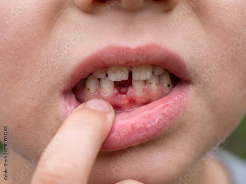 Close up of child with injured bleeding front tooth.