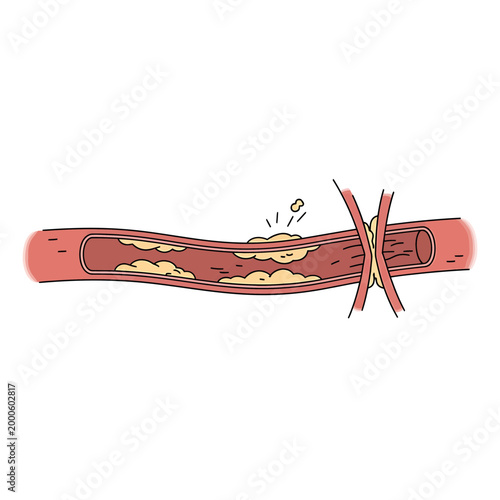 Medical Illustration of Artery with Plaque Buildup and Blockage