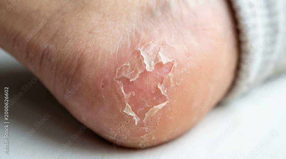 Fototapeta premium Skin peeling from friction on heel, showing dryness and irritation. Close-up of foot with cracked and flaky skin, highlighting the effects of friction and moisture loss.